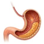 هل حرقة المعدة دائمًا مؤشر على مشكلة صحية خطيرة؟