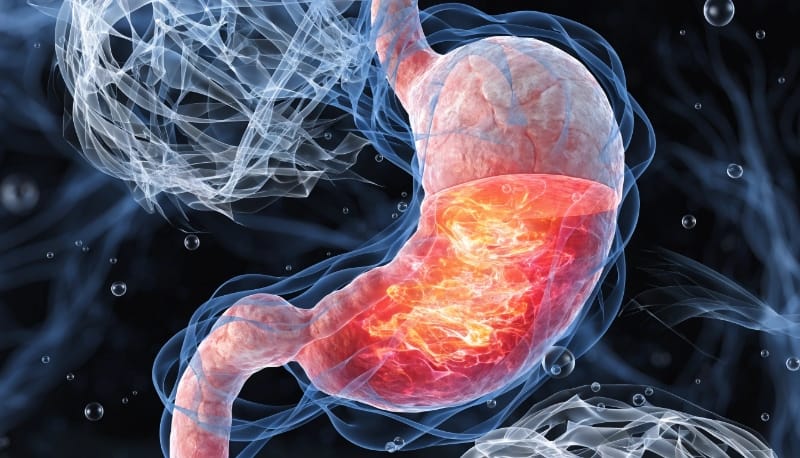 زيادة حمض المعدة بسبب التوتر