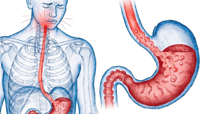 ألم الصدر الناتج عن ارتجاع المريء