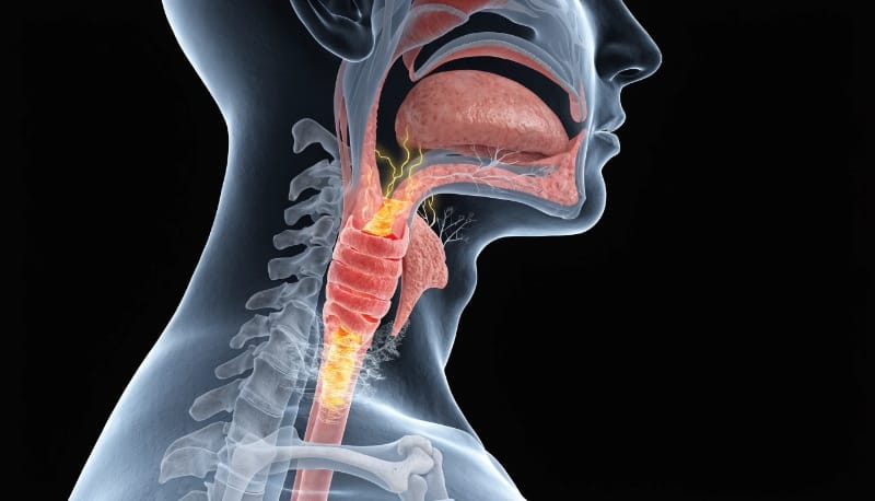 التهاب الحلق بسبب ارتجاع المريء