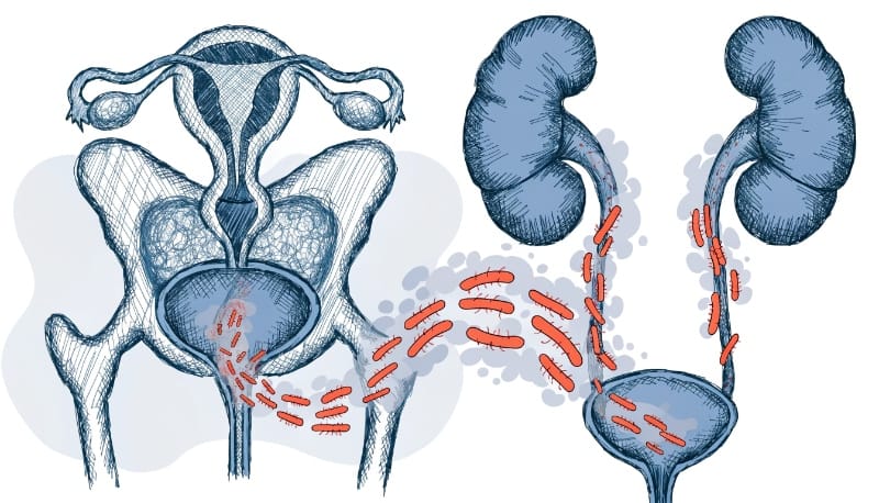 صعود البكتيريا إلى المثانة