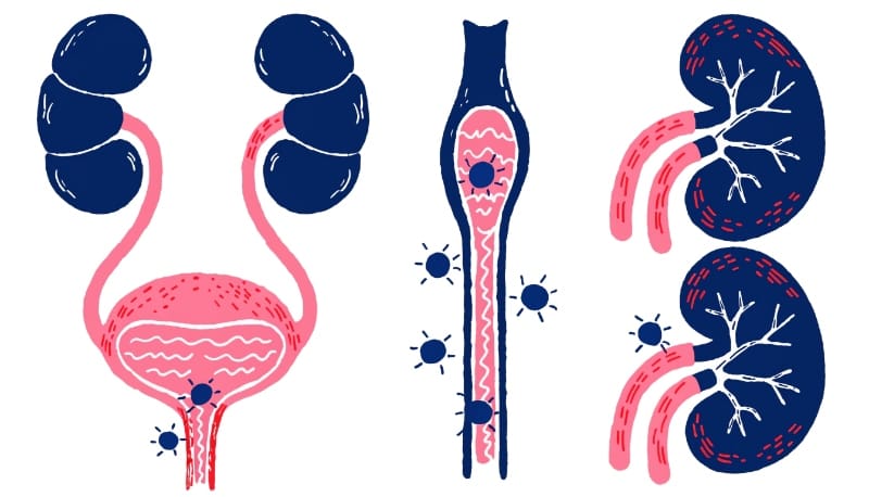أنواع التهابات المسالك البولية